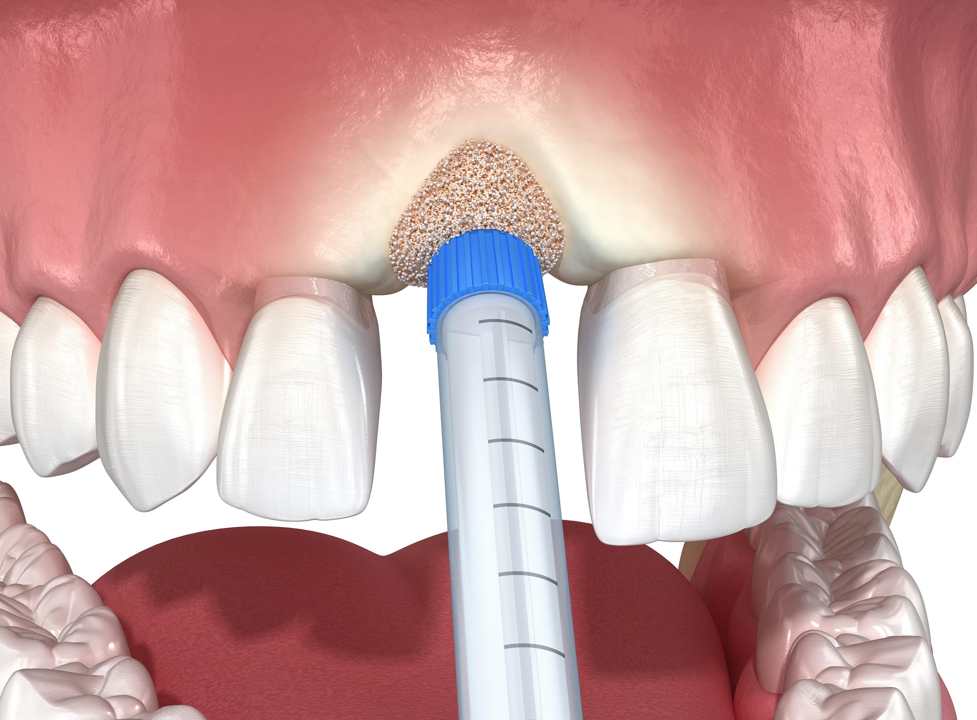 Tooth loss can lead to jawbone shrinkage, causing up to 25% bone loss in the first year.