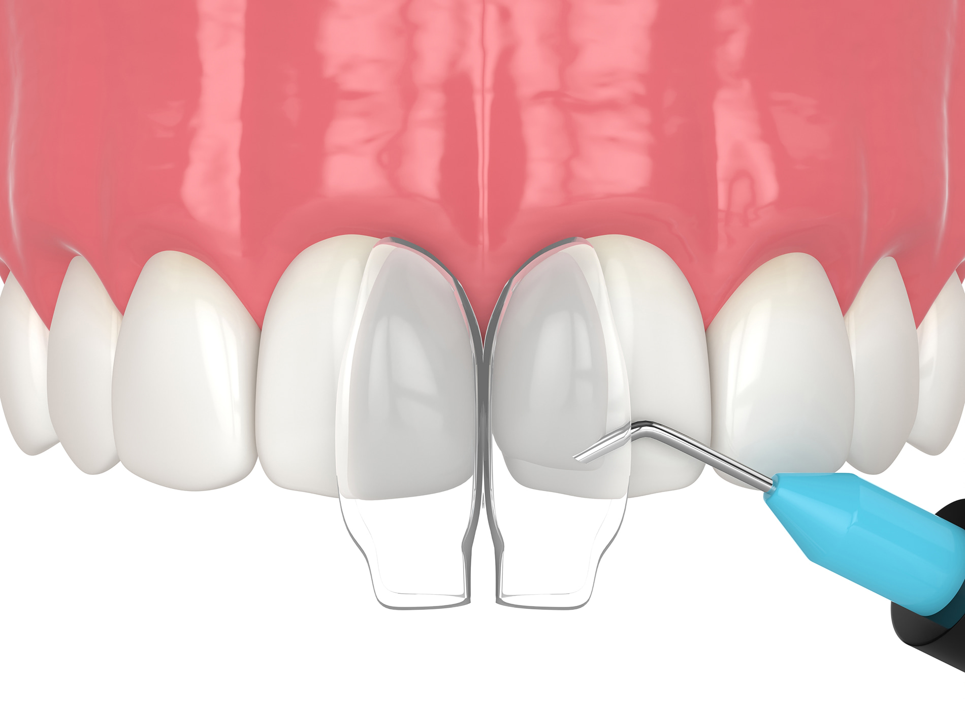 Quick and effective dental bonding for minor tooth imperfections.