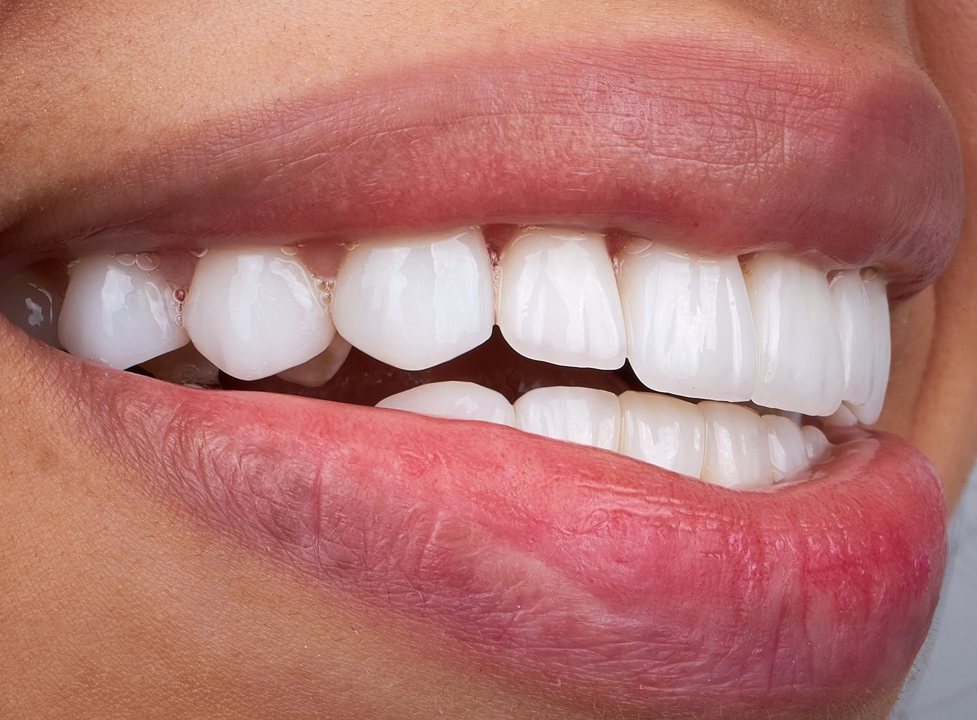 Proper care keeps bonded teeth healthy and looking natural.