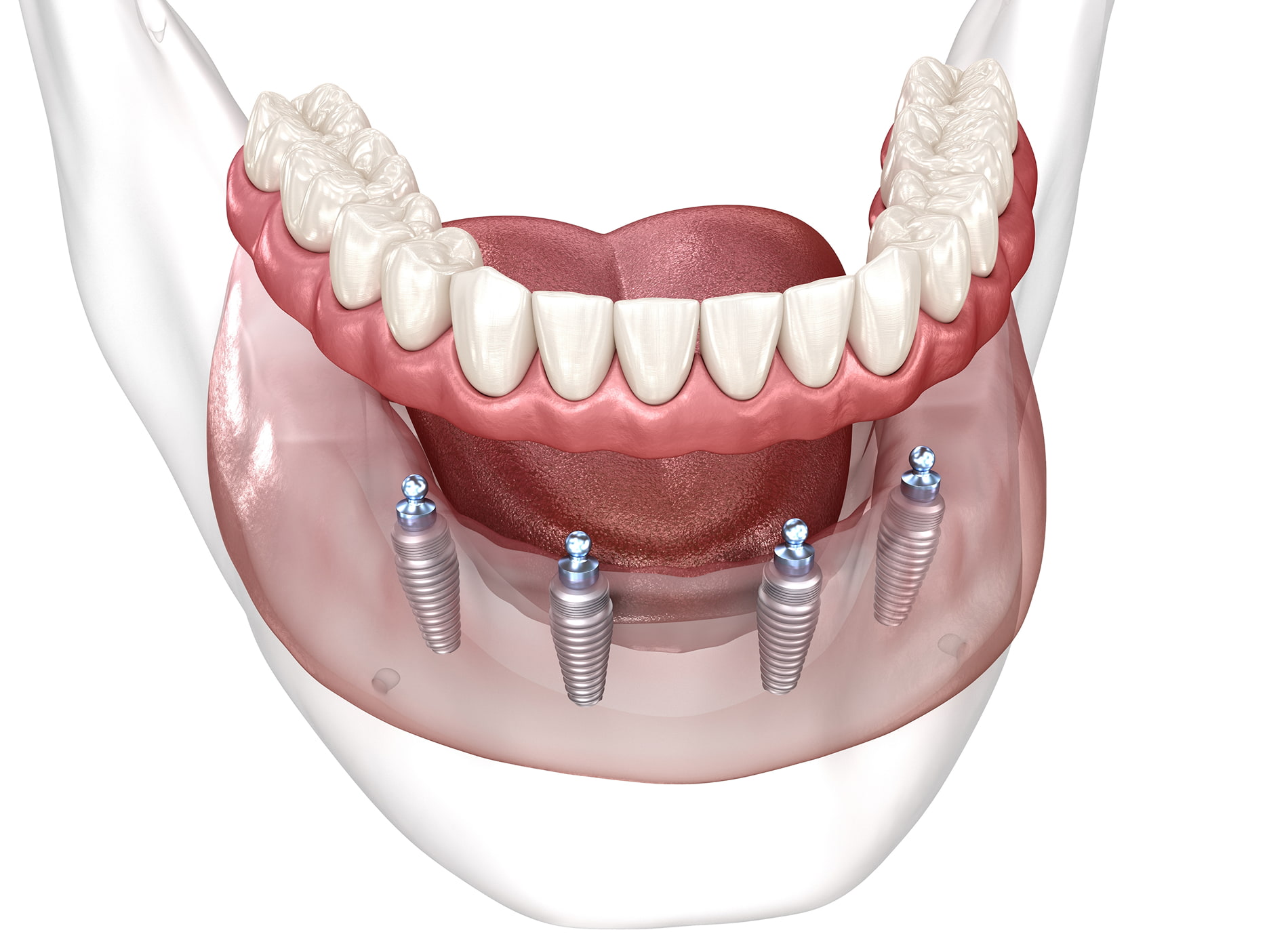 Dentures improve your smile’s appearance but cannot prevent jawbone loss over time.