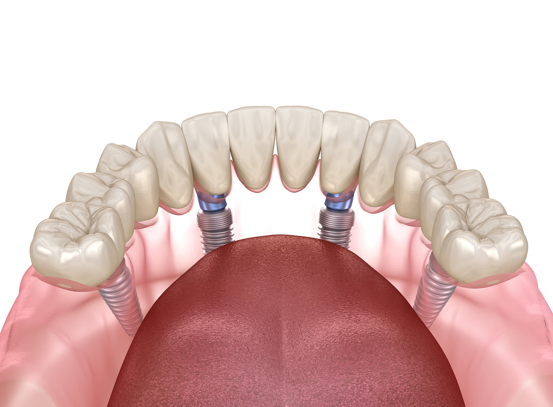 Proper care for All-on-4® implants includes daily brushing, flossing, and regular dental checkups.