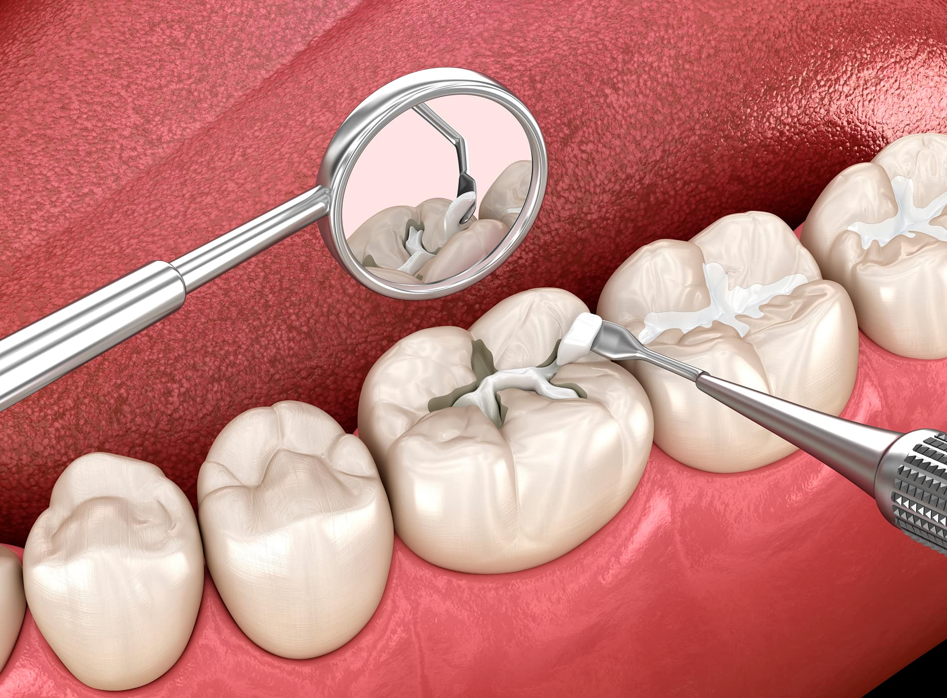 Dental sealants protect hard-to-clean grooves and prevent cavities at Dullat Cosmetic Dental & Implants.