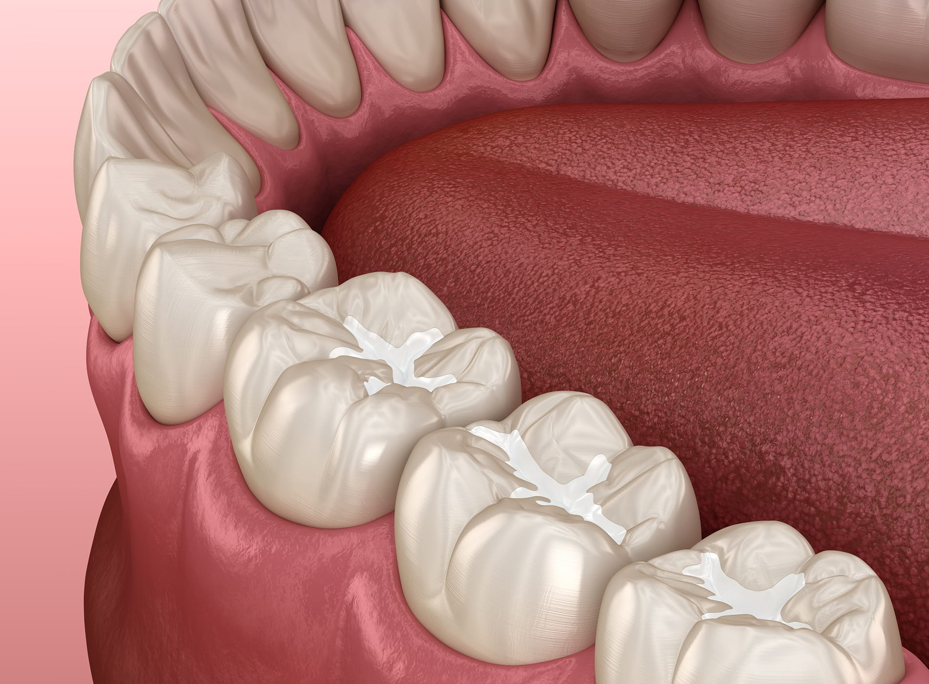 Deep grooves in teeth can trap food and bacteria, making them hard to clean with a toothbrush.