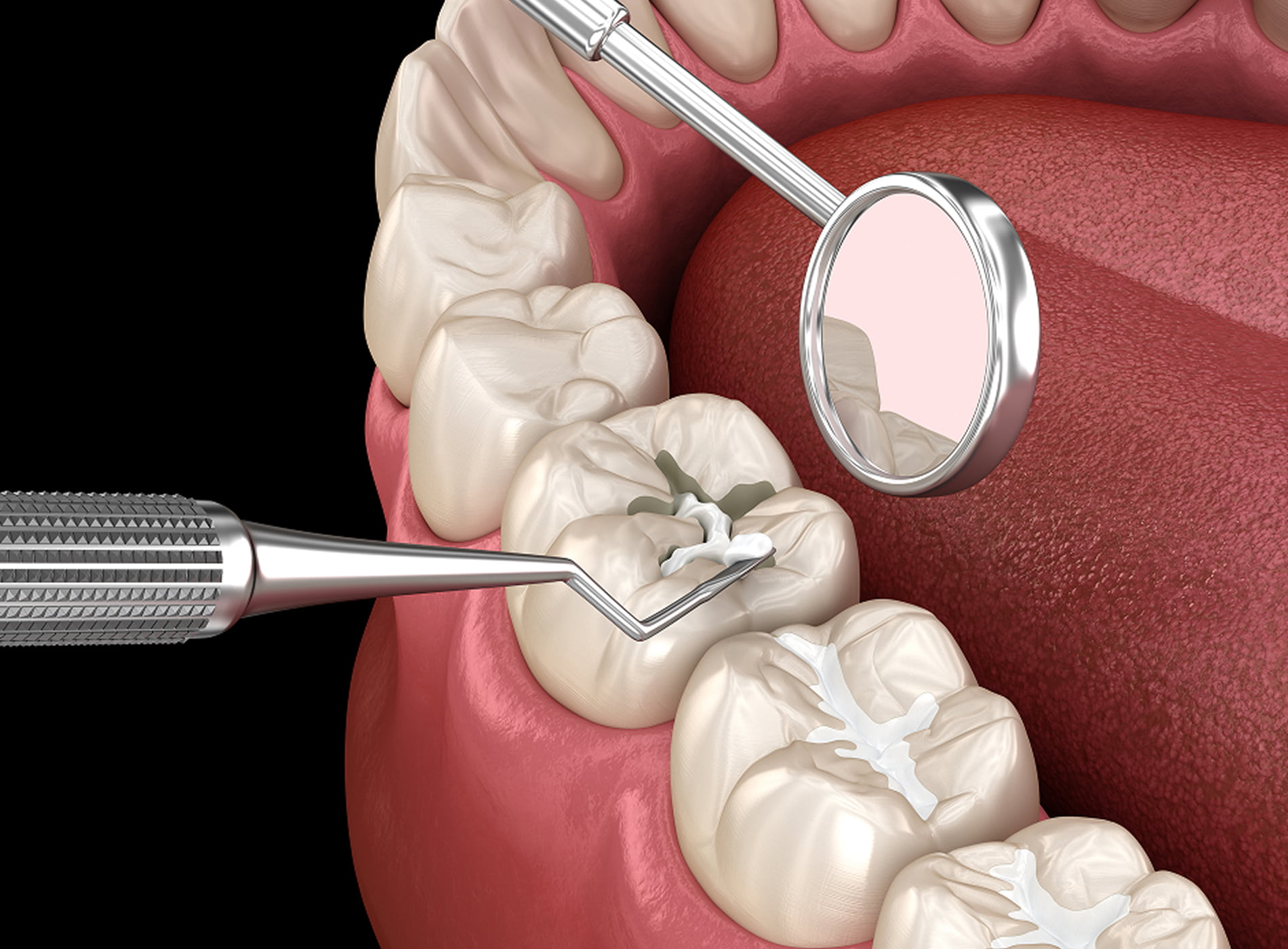 Dental sealants are a quick, painless, and non-invasive way to protect teeth.