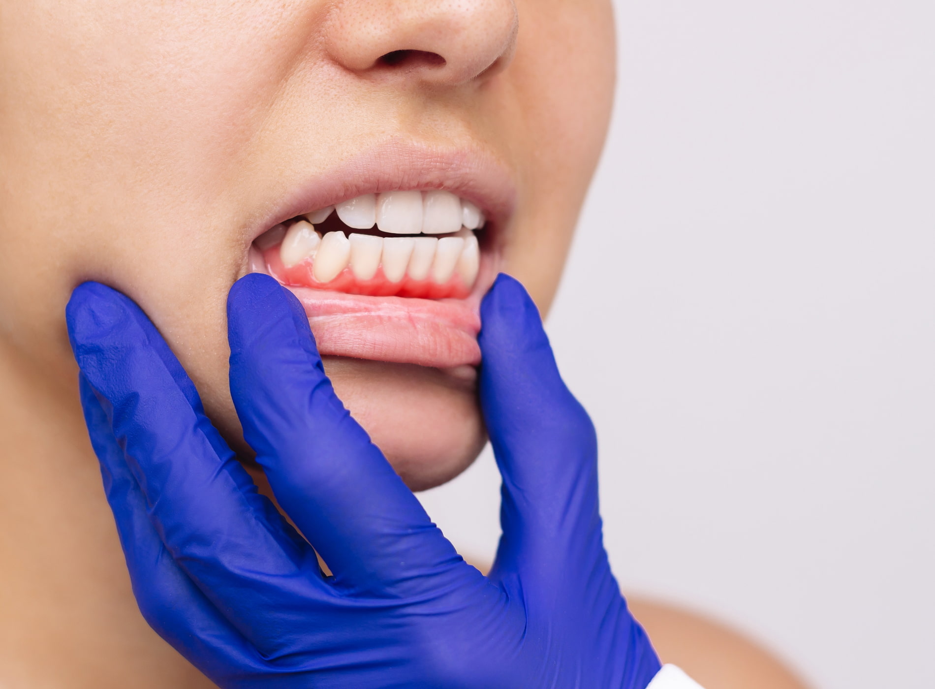 Gum disease treatment at Dullat Cosmetic Dental & Implants restores healthy gums and protects your smile.