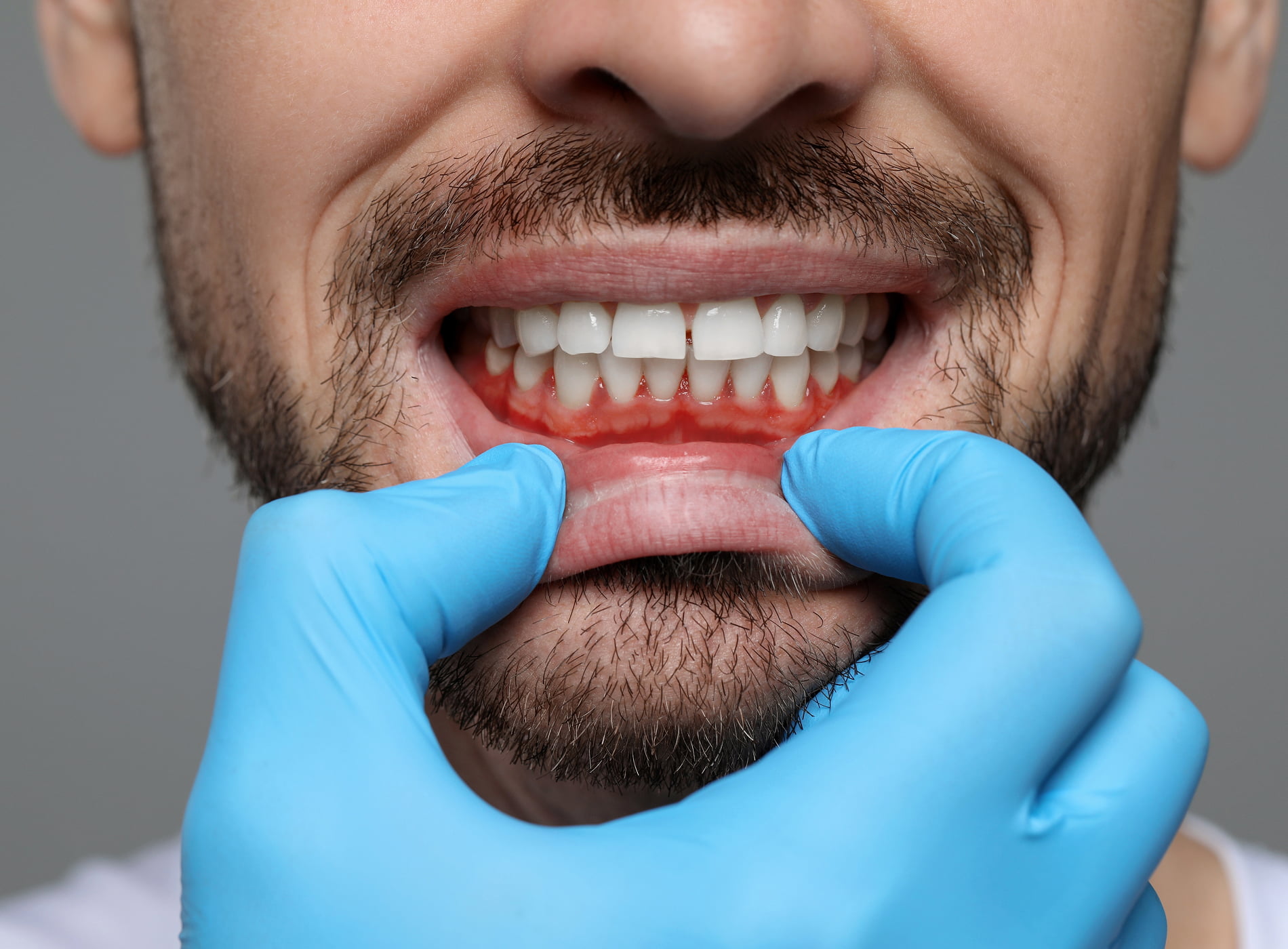 A patient receiving a scaling and root planing treatment at Dullat Cosmetic Dental & Implants.