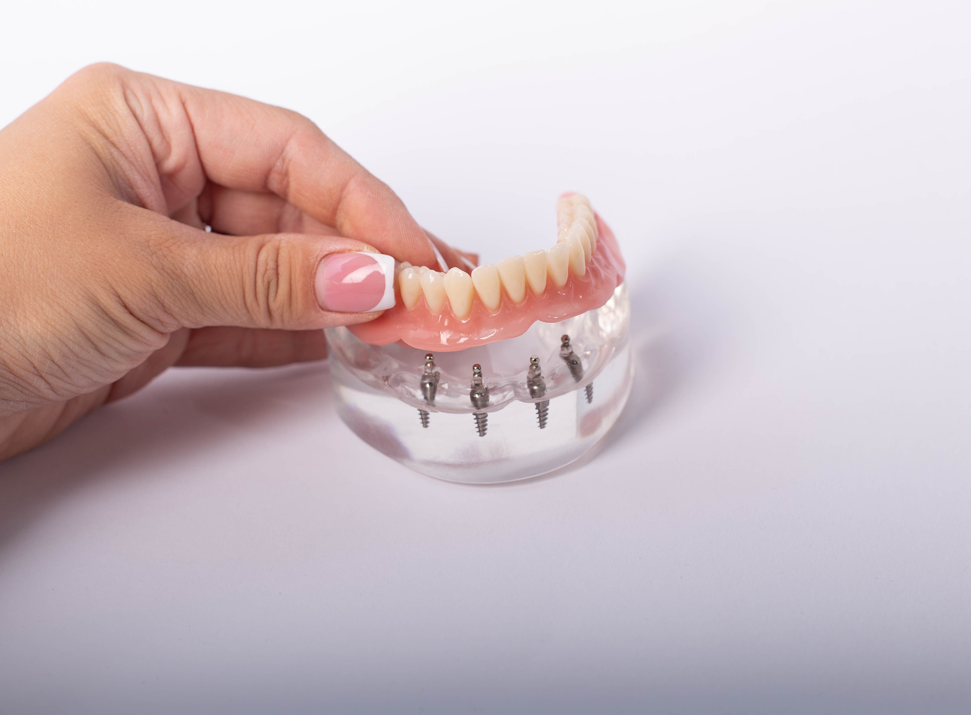 Implant dentures at Dullat Cosmetic Dental & Implants in San Jose