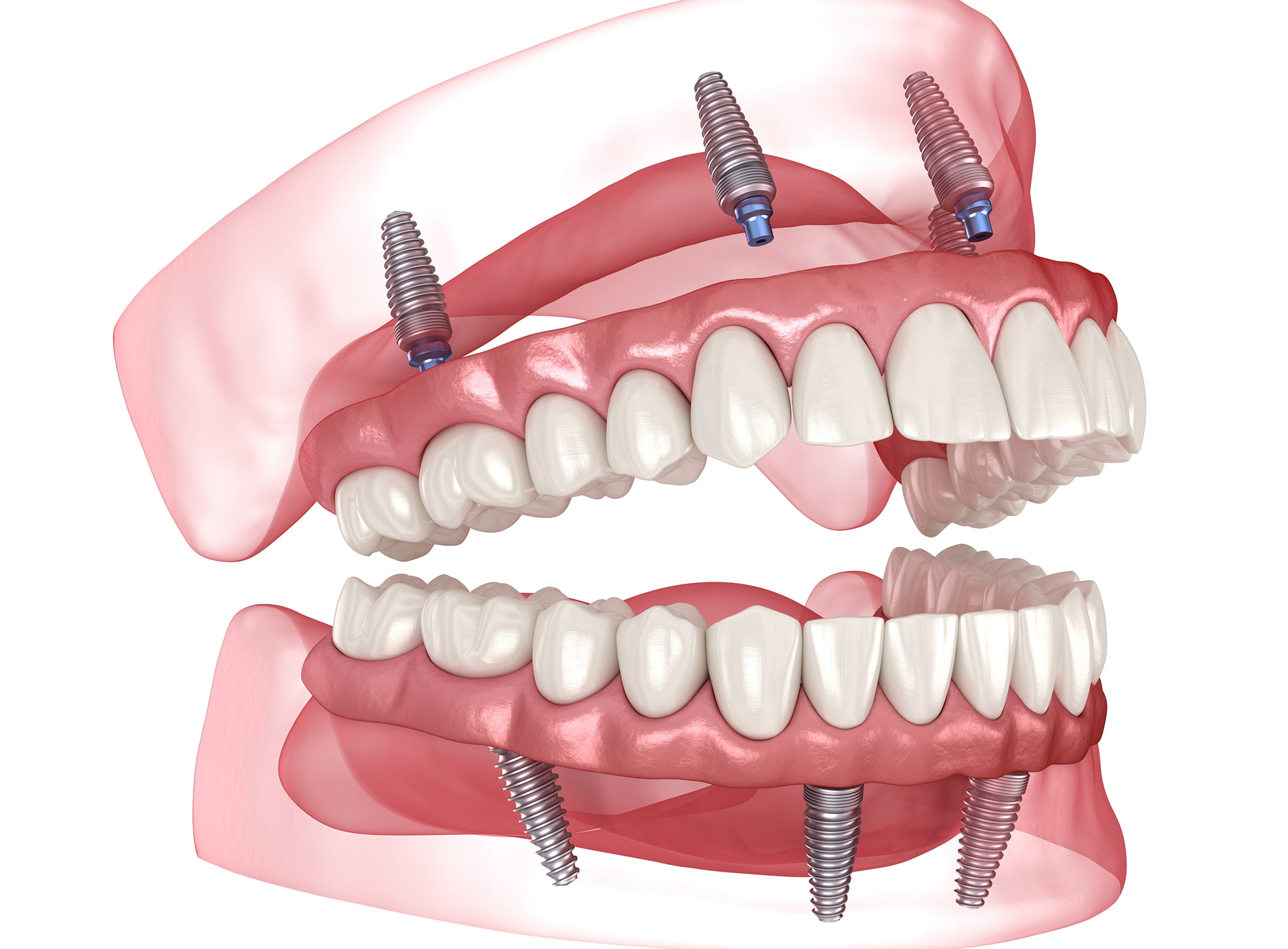 Implant dentures trusted by San Jose patients at Dullat Cosmetic Dental & Implants