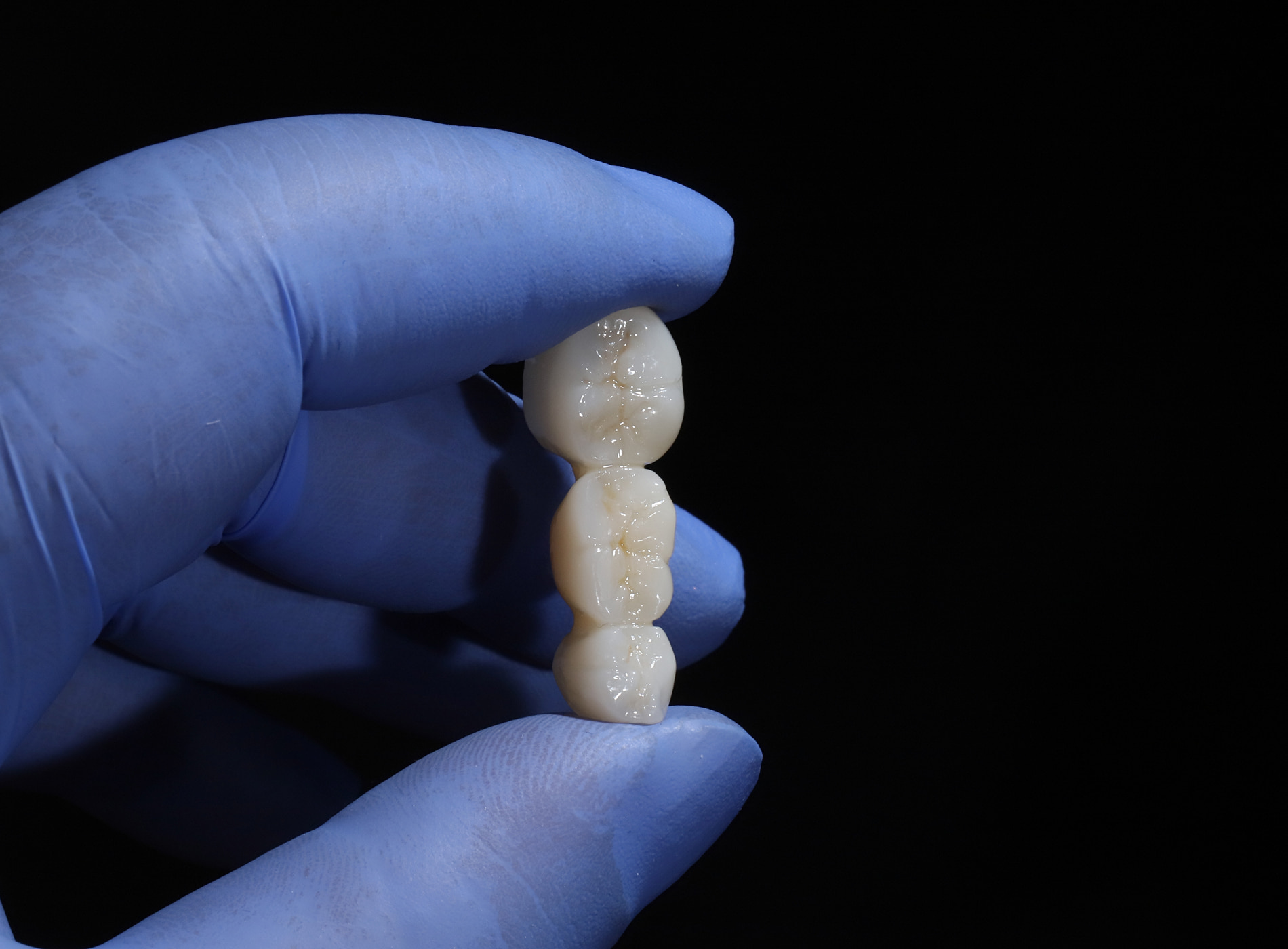 Implant-supported bridges trusted by San Jose patients at Dullat Cosmetic Dental & Implants