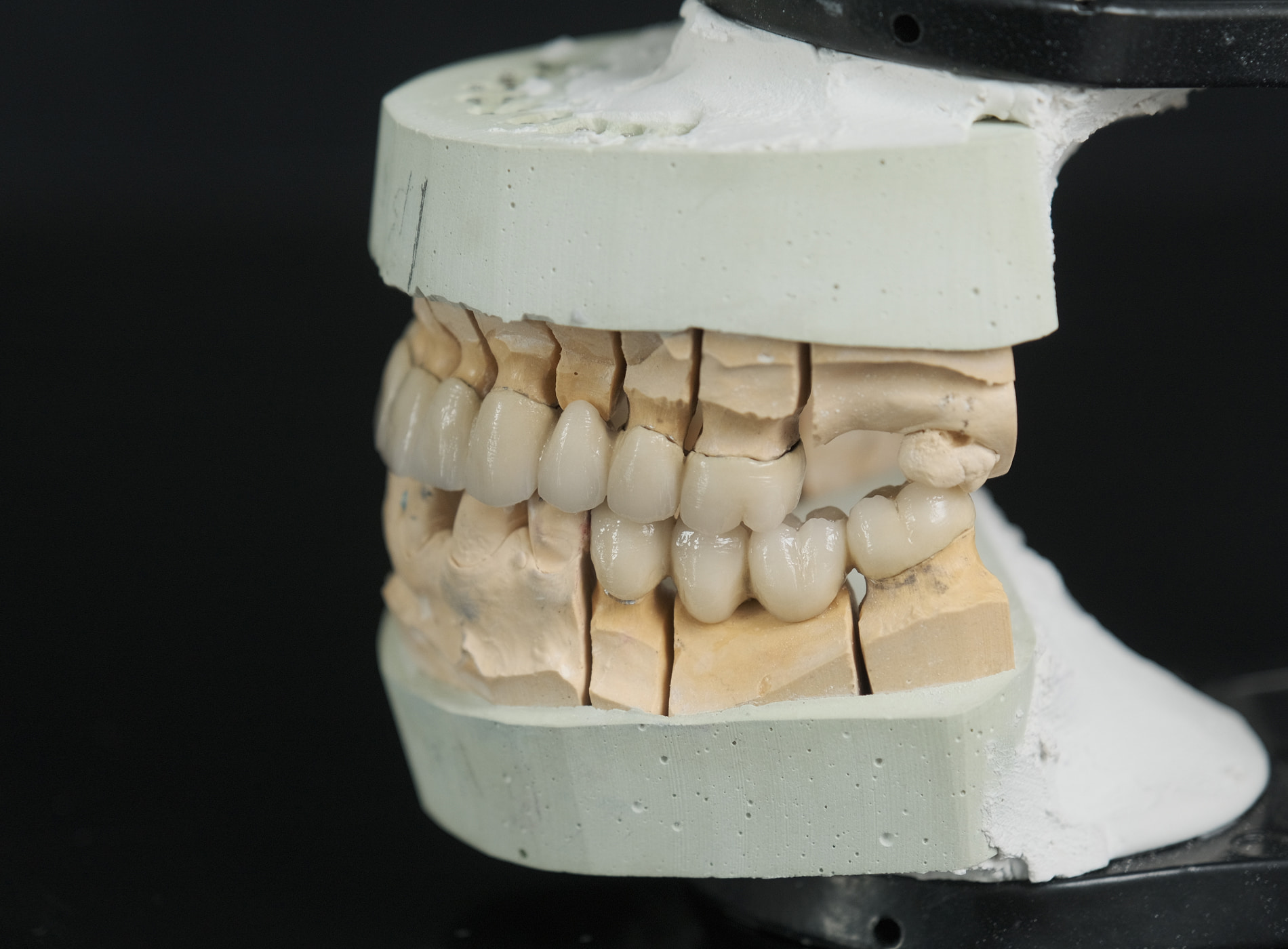 Metal-free dental crowns at Dullat Cosmetic Dental & Implants in San Jose