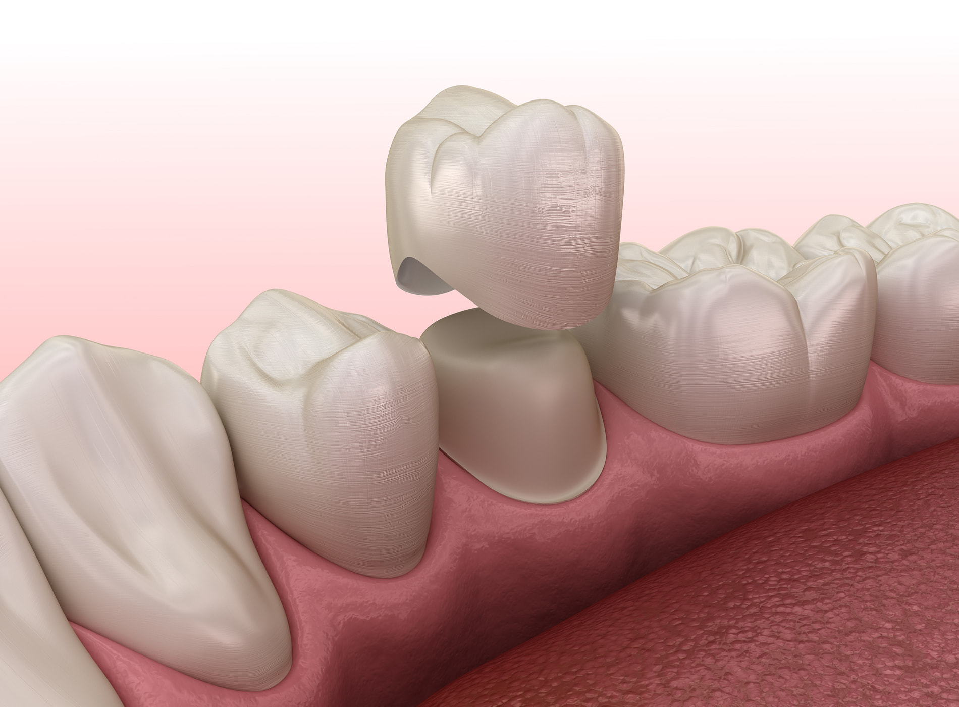 Long-lasting metal-free dental crowns with proper care