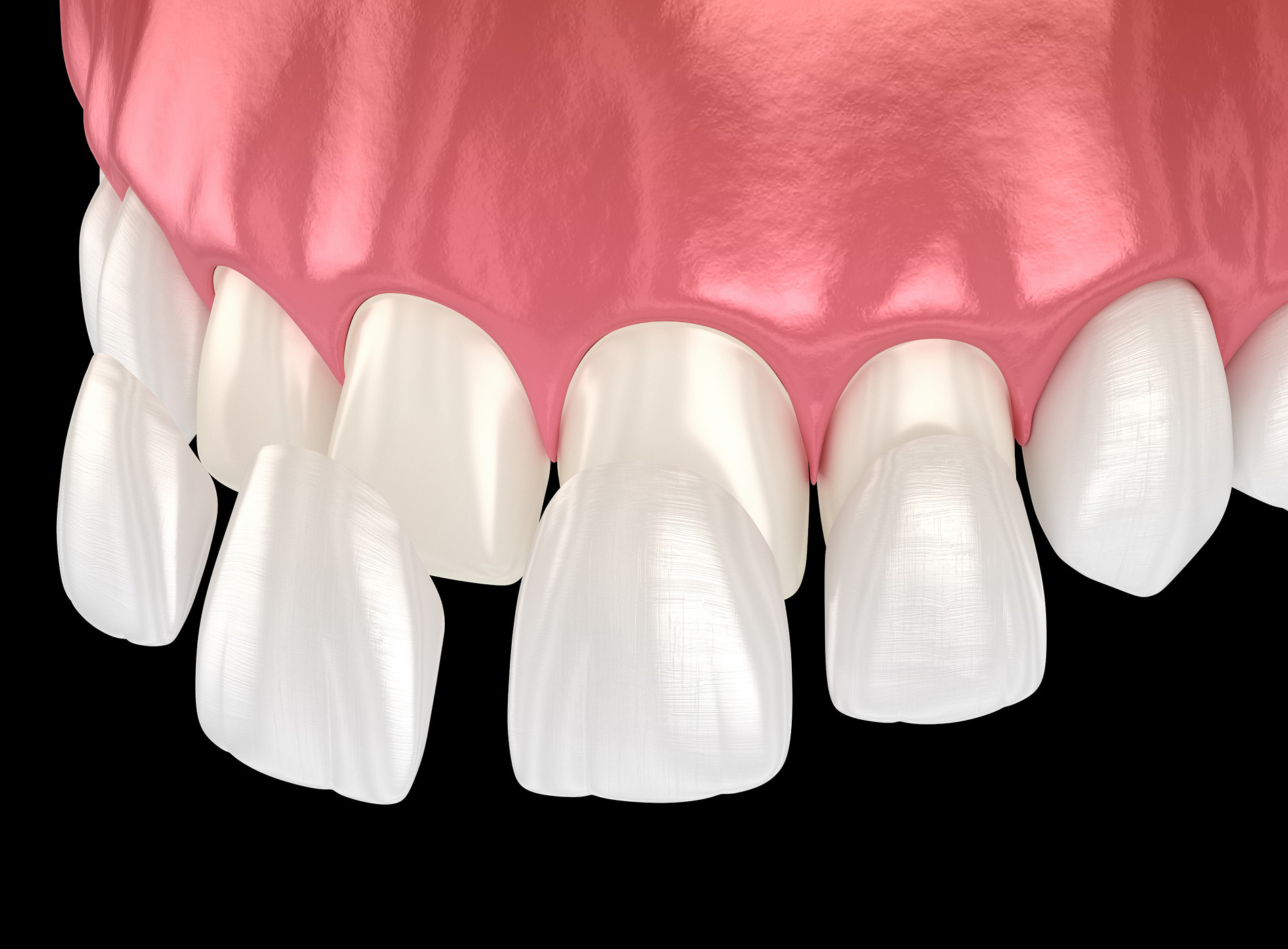 Custom porcelain veneers preserving natural teeth and enhancing smiles