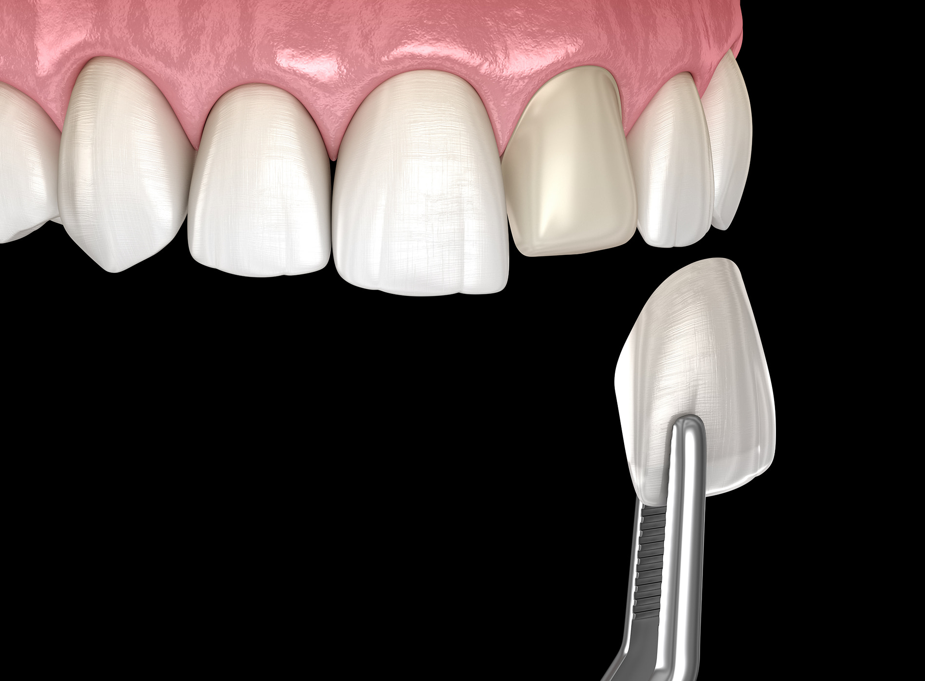 Proper care ensures long-lasting porcelain veneers