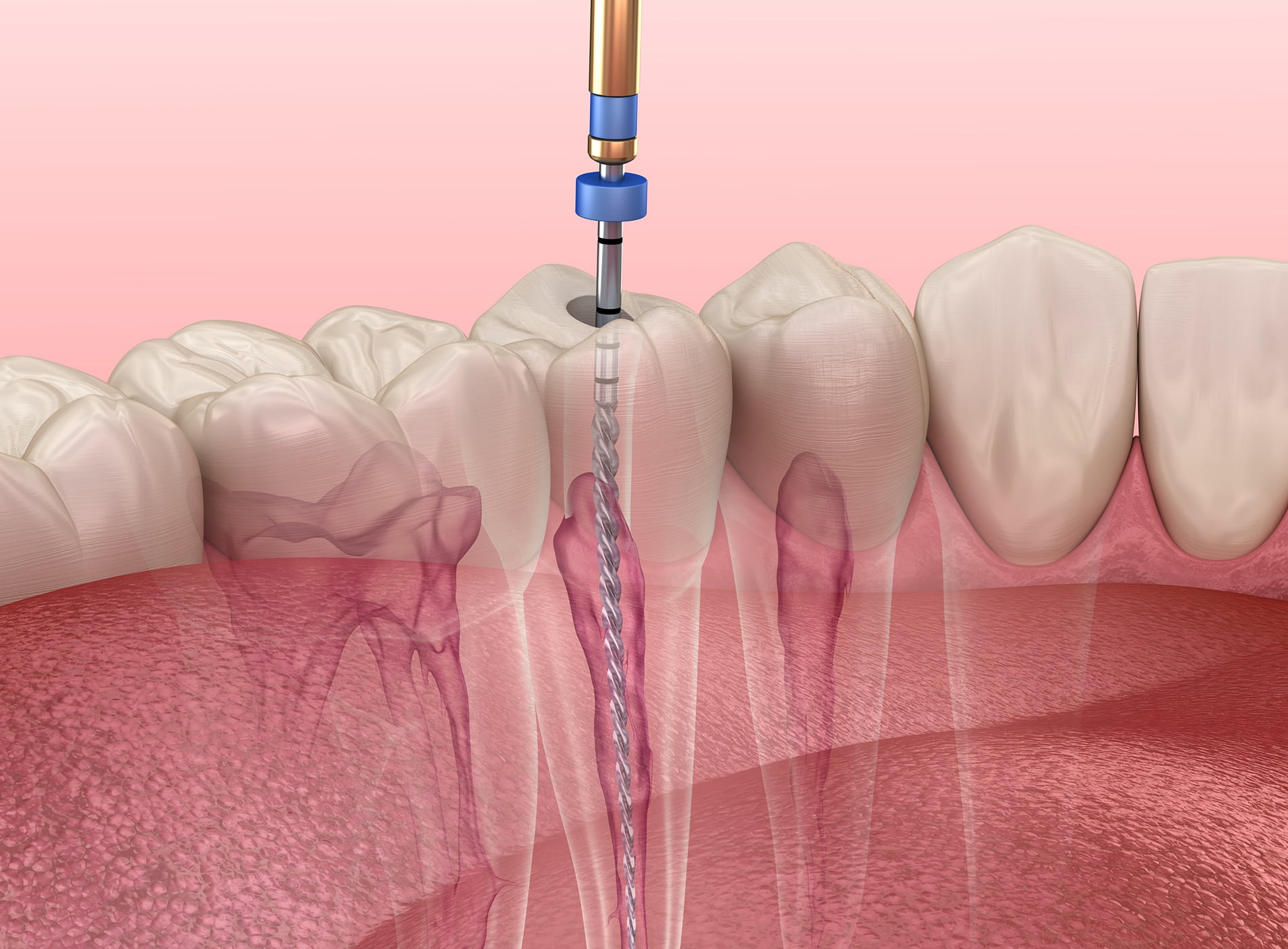 Comfortable root canal treatment at Dullat Cosmetic Dental & Implants in San Jose