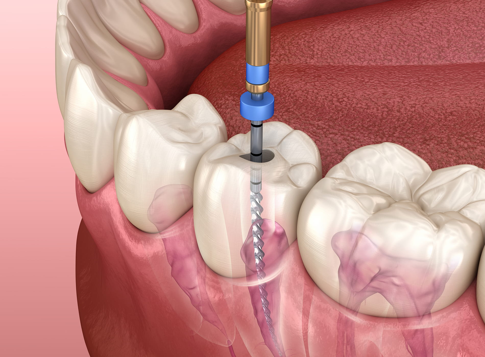 Root canal aftercare tips for quick healing and lasting comfort