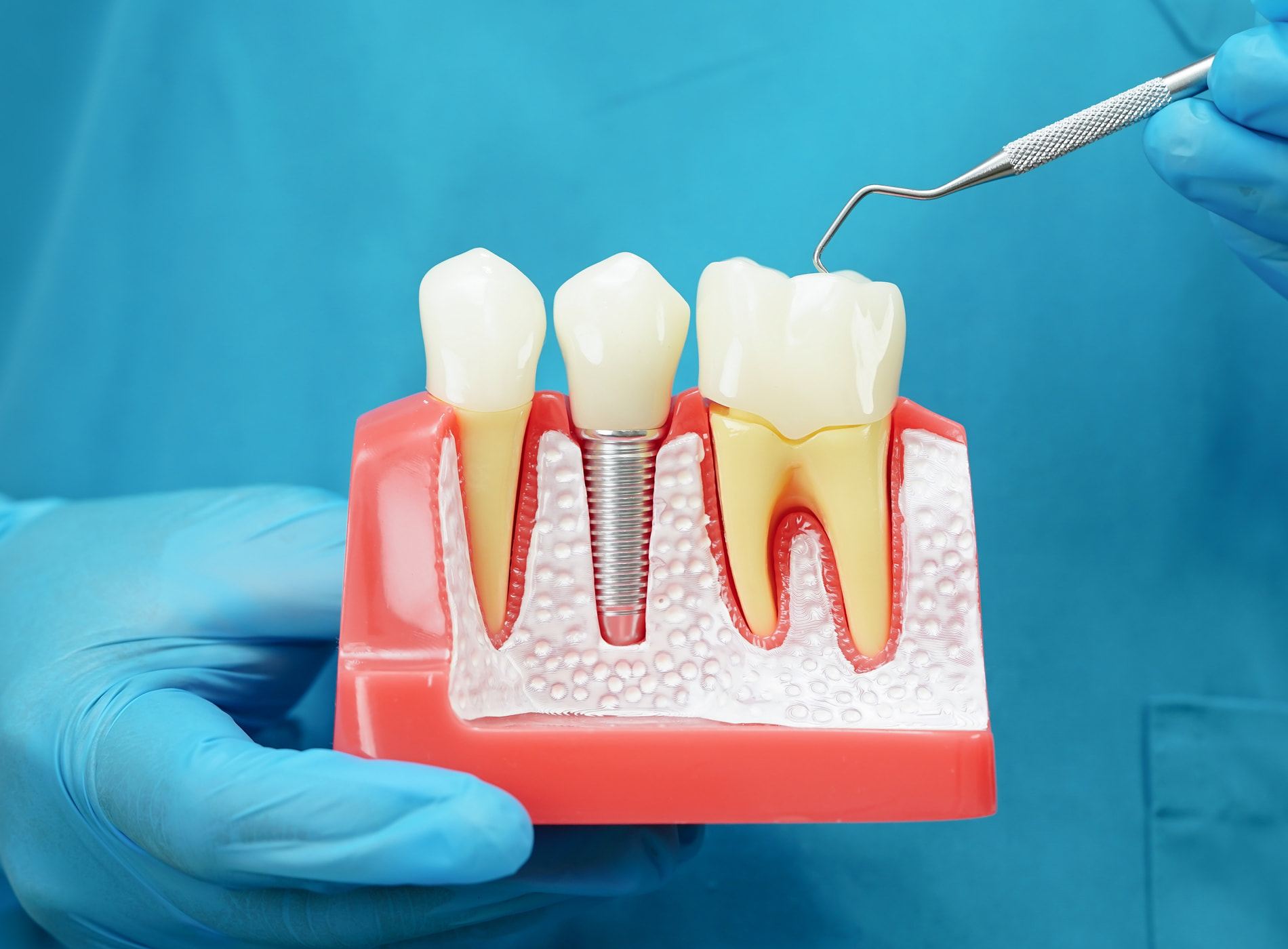 Single tooth dental implants at Dullat Cosmetic Dental & Implants in San Jose