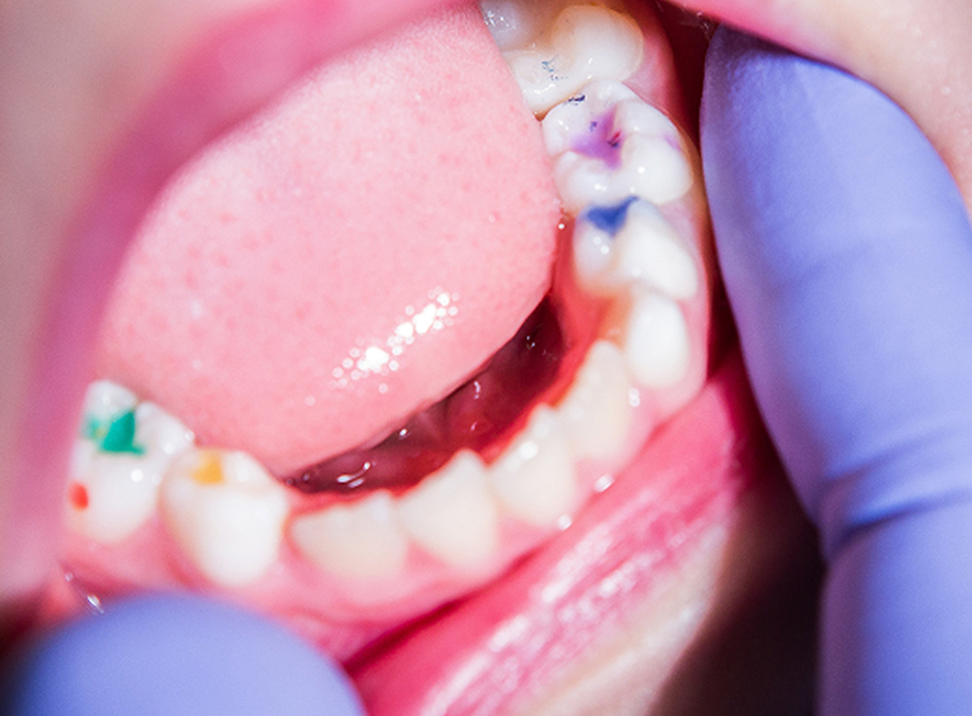 Composite tooth-colored fillings for natural-looking smiles at Dullat Cosmetic Dental & Implants