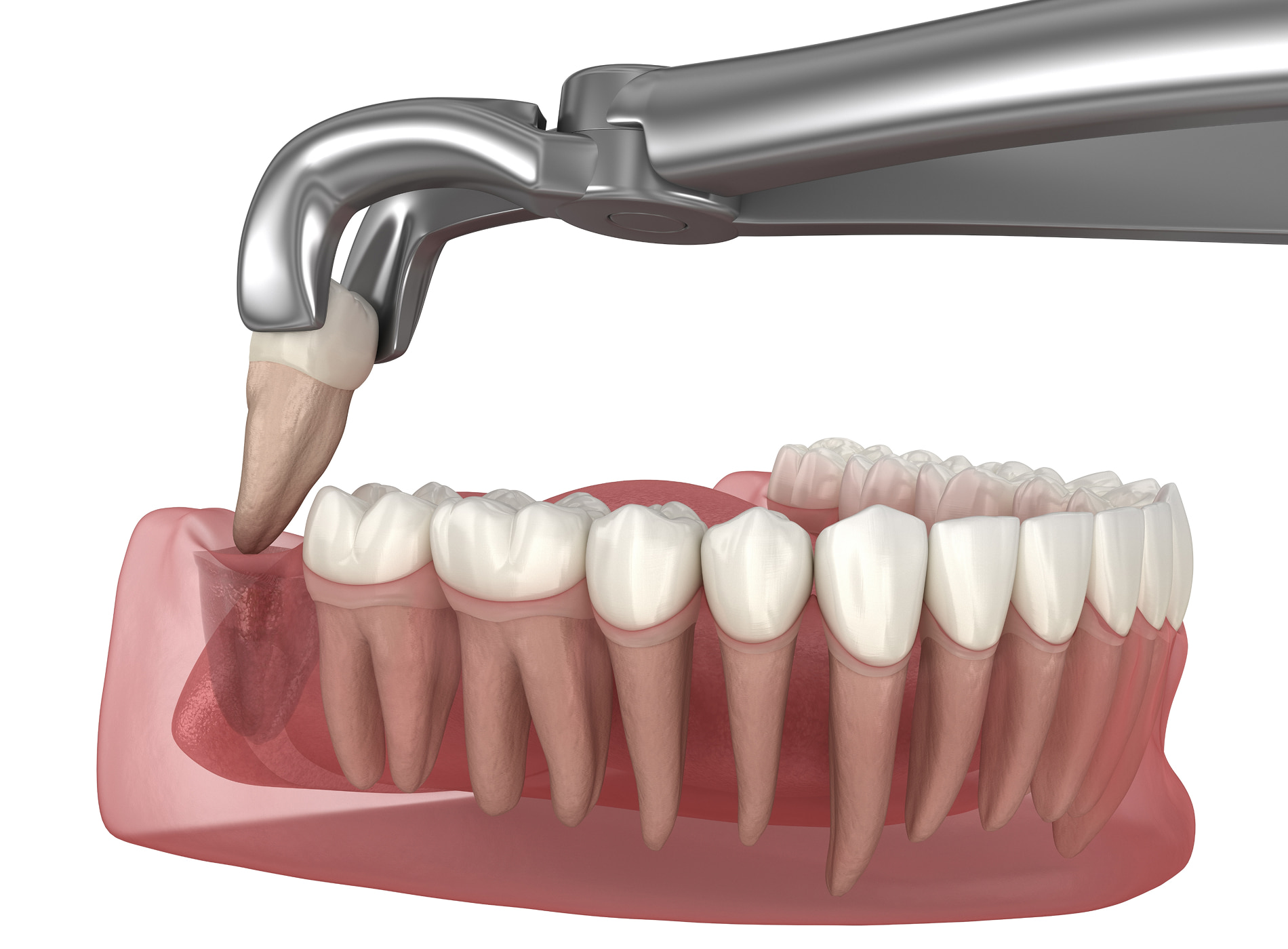 Situations where tooth extraction is necessary for oral health